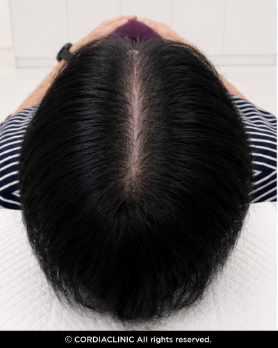 앞머리 탈모, 갱년기 여성이라면 지금 확인해 보세요. 사진 3