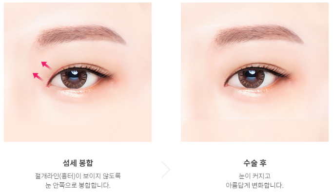 에이펙스성형외과 트임성형, 가로 세로 길이 확장으로 시원한 눈매 사진 8