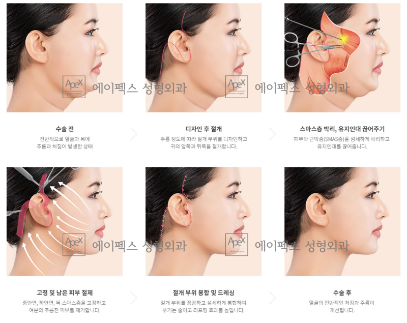 탄력있는 V라인 얼굴, 안면거상은 에이펙스성형외과