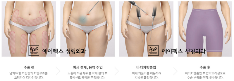 에이펙스성형외과에서 뱃살, 옆구리살, 지방흡입으로 매끈하게 정리하자!