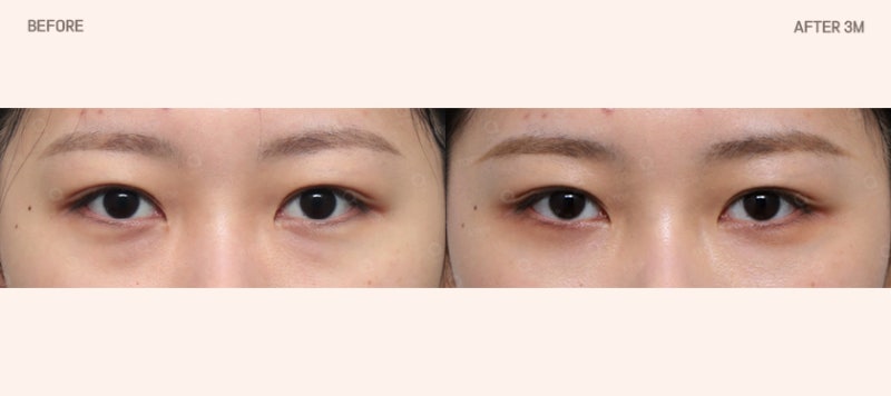 눈밑지방재배치, 단순히 지방을 없애는 수술일까? 사진 2