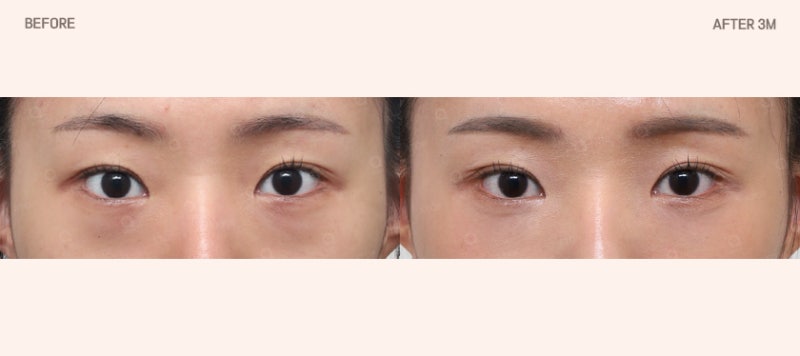 눈밑지방재배치, 단순히 지방을 없애는 수술일까? 사진 3