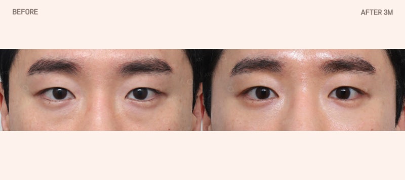 눈밑지방재배치, 단순히 지방을 없애는 수술일까?