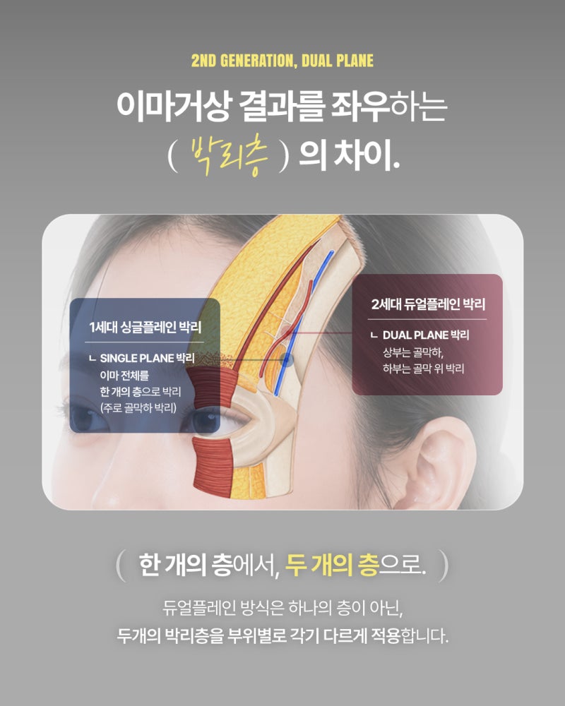 5포인트 절개는 그대로, 박리층은 다르게｜2세대 듀얼 플레인 이마거상 사진 4