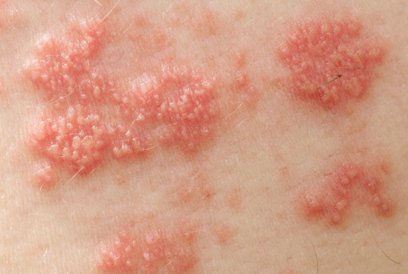 Vaksinasi Herpes Zoster, Apa Perbedaan Jenis Vaksinnya?