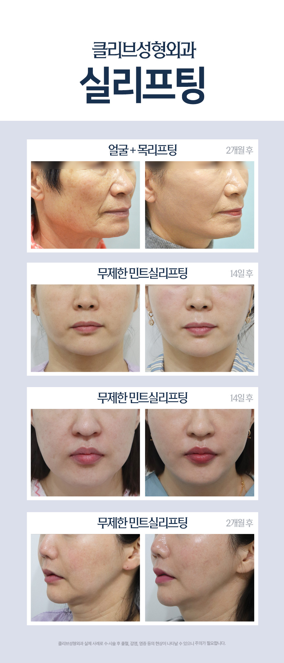 광대실리프팅·입꼬리실리프팅, 중안면리프팅이 필요한 얼굴은? 사진 8