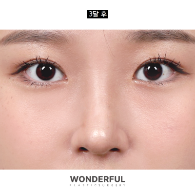 코안실밥Ⅰ눈코수술 5일차 리얼 후기 Ⅰ주차별 전후 비교 사진 9
