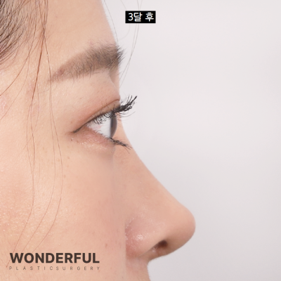 코안실밥Ⅰ눈코수술 5일차 리얼 후기 Ⅰ주차별 전후 비교 사진 11
