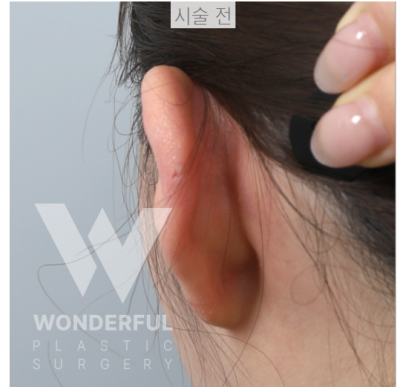 요즘 대세 요정 귀 " 진짜 효과 좋나요?" 귀 필러 직 후 비교 사진 8