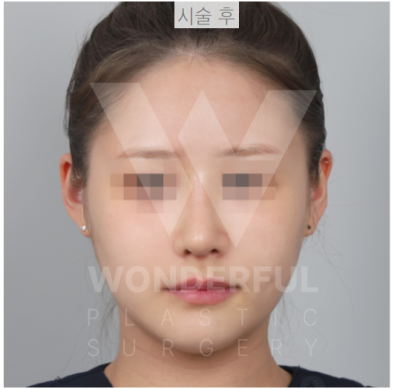 요즘 대세 요정 귀 " 진짜 효과 좋나요?" 귀 필러 직 후 비교 사진 5