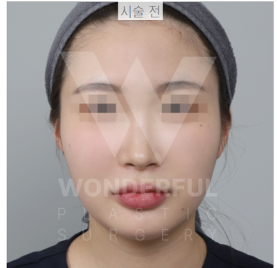 요즘 대세 요정 귀 " 진짜 효과 좋나요?" 귀 필러 직 후 비교 사진 6