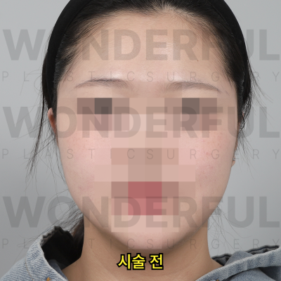 귀필러 시술효과, 교정 전후비교, 붓기,통증 정리 사진 10
