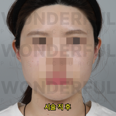 귀필러 시술효과, 교정 전후비교, 붓기,통증 정리 사진 15