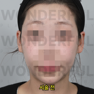 귀필러 시술효과, 교정 전후비교, 붓기,통증 정리 사진 12