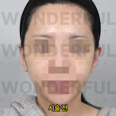 귀필러 시술효과, 교정 전후비교, 붓기,통증 정리 사진 6
