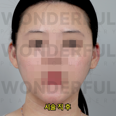 귀필러 시술효과, 교정 전후비교, 붓기,통증 정리 사진 9