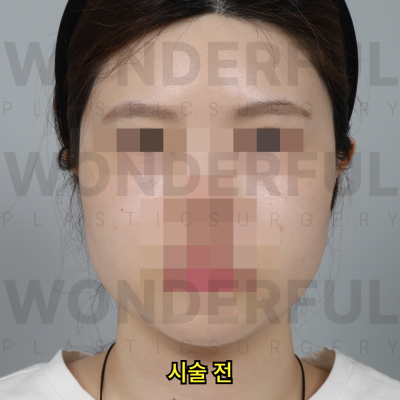 귀필러 시술효과, 교정 전후비교, 붓기,통증 정리 사진 14
