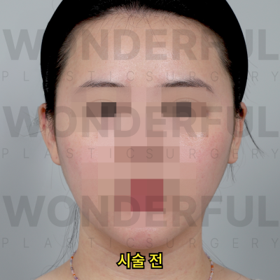 귀필러 시술효과, 교정 전후비교, 붓기,통증 정리 사진 8