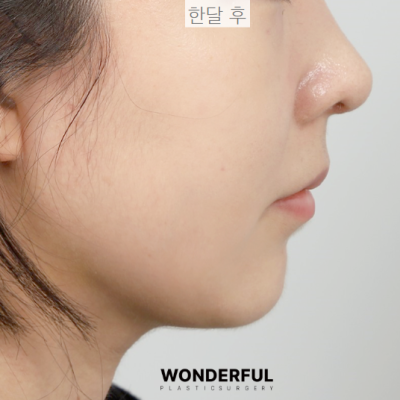 턱살, 옆선라인 확실한 교정 방법! 사진 12