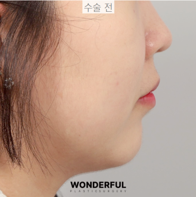 턱살, 옆선라인 확실한 교정 방법! 사진 11