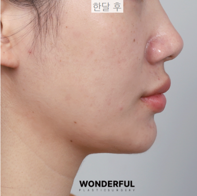 턱살, 옆선라인 확실한 교정 방법! 사진 10