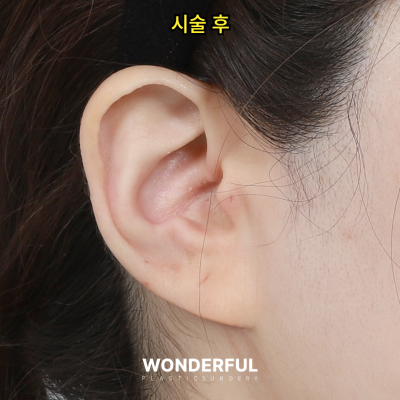 귀필러 효과 총정리! 중안부,광대,비대칭 비교 사진 13