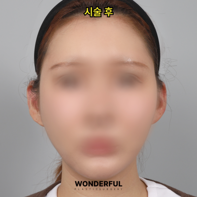 귀필러 효과 총정리! 중안부,광대,비대칭 비교 사진 7