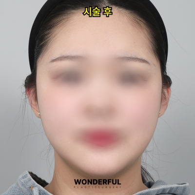 귀필러 효과 총정리! 중안부,광대,비대칭 비교 사진 5