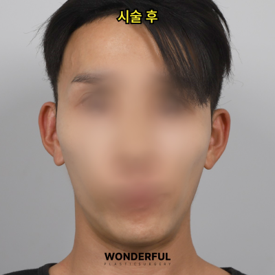 귀필러 효과 총정리! 중안부,광대,비대칭 비교 사진 11