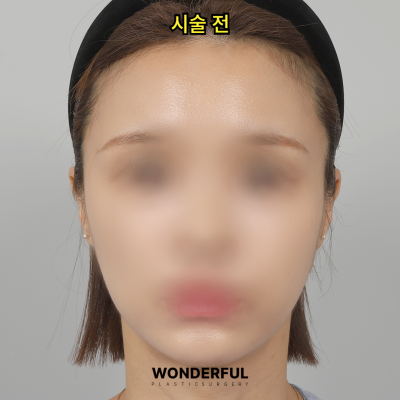 귀필러 효과 총정리! 중안부,광대,비대칭 비교 사진 8