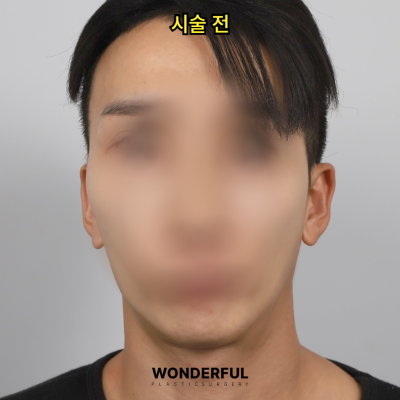 귀필러 효과 총정리! 중안부,광대,비대칭 비교 사진 10