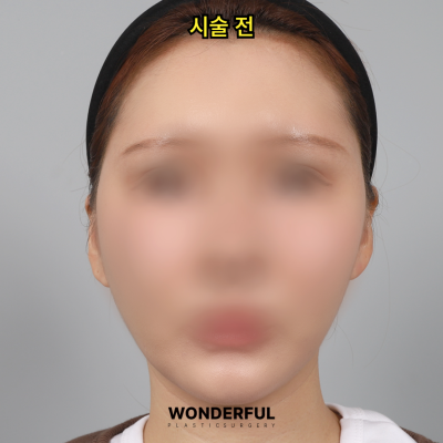 귀필러 효과 총정리! 중안부,광대,비대칭 비교 사진 6