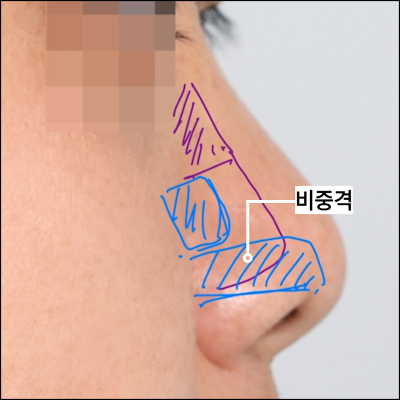 들창코,짧은코,복코,메부리 수술법 *꼭 확인하세요* 사진 6
