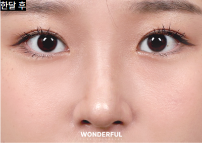 라식 먼저? 쌍꺼풀 수술 먼저? 사진 12