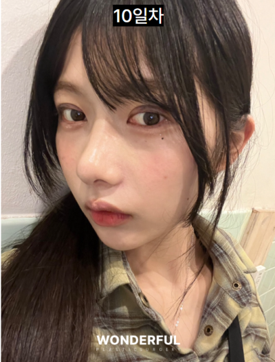 일본인이 한국에서 성형한 이유/눈,무보형물 코 후기 사진 8