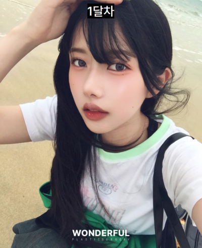 일본인이 한국에서 성형한 이유/눈,무보형물 코 후기 사진 10