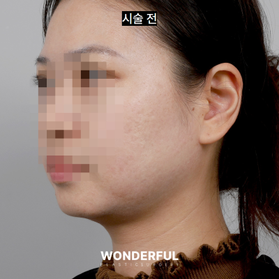 수술 없이 얼굴 윤곽 살리기/ 이중턱 전후 비교 사진 7