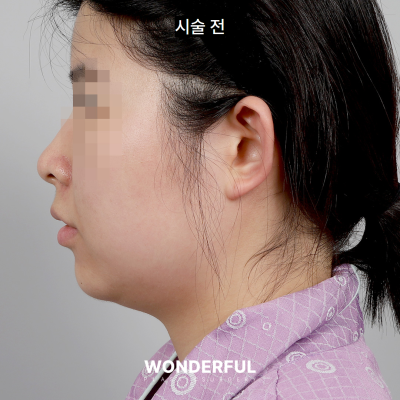 수술 없이 얼굴 윤곽 살리기/ 이중턱 전후 비교 사진 9
