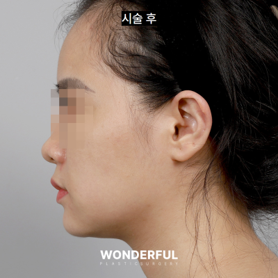 수술 없이 얼굴 윤곽 살리기/ 이중턱 전후 비교 사진 6