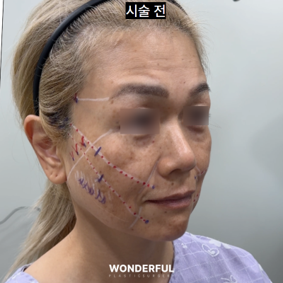10년 젊어보이는 동안 시술 4가지 (50대 꼭보세요) 사진 6