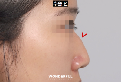 매부리 복코 확실한 교정법 사진 6