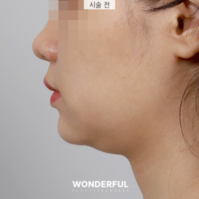 새학기에 붓기없이 예뻐지는 시술 3가지 추천! 사진 9