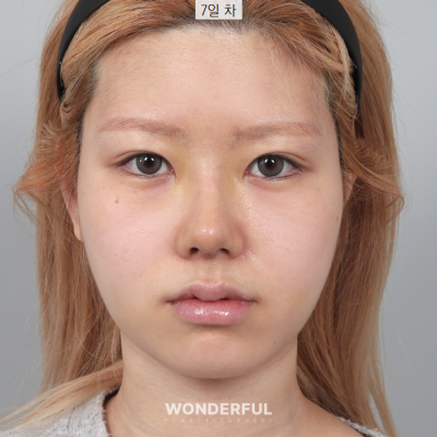 코 수술후 과교정 기간, 변화과정 보여드립니다. 사진 6
