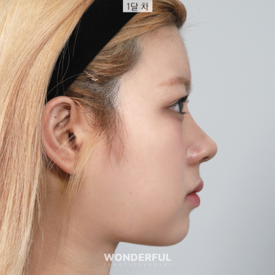 코 수술후 과교정 기간, 변화과정 보여드립니다. 사진 4