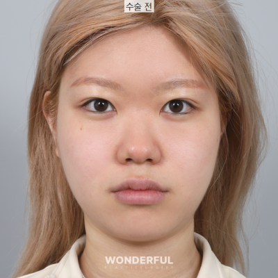 코 수술후 과교정 기간, 변화과정 보여드립니다. 사진 5