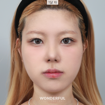 코 수술후 과교정 기간, 변화과정 보여드립니다. 사진 7