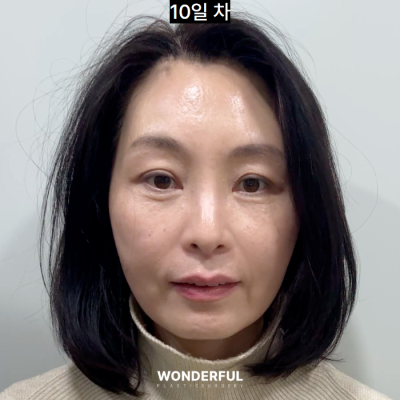 이마거상 한달차 QnA , 회복 과정, 가격 사진 10