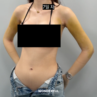 여름 앞두고 지흡 고민이시면 보세요. 수술시기, 압박복, 흉터 사진 11