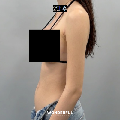 여름 앞두고 지흡 고민이시면 보세요. 수술시기, 압박복, 흉터 사진 13