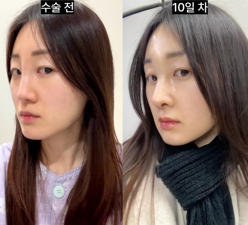 콧대필러 하고 다시 코수술한 후기